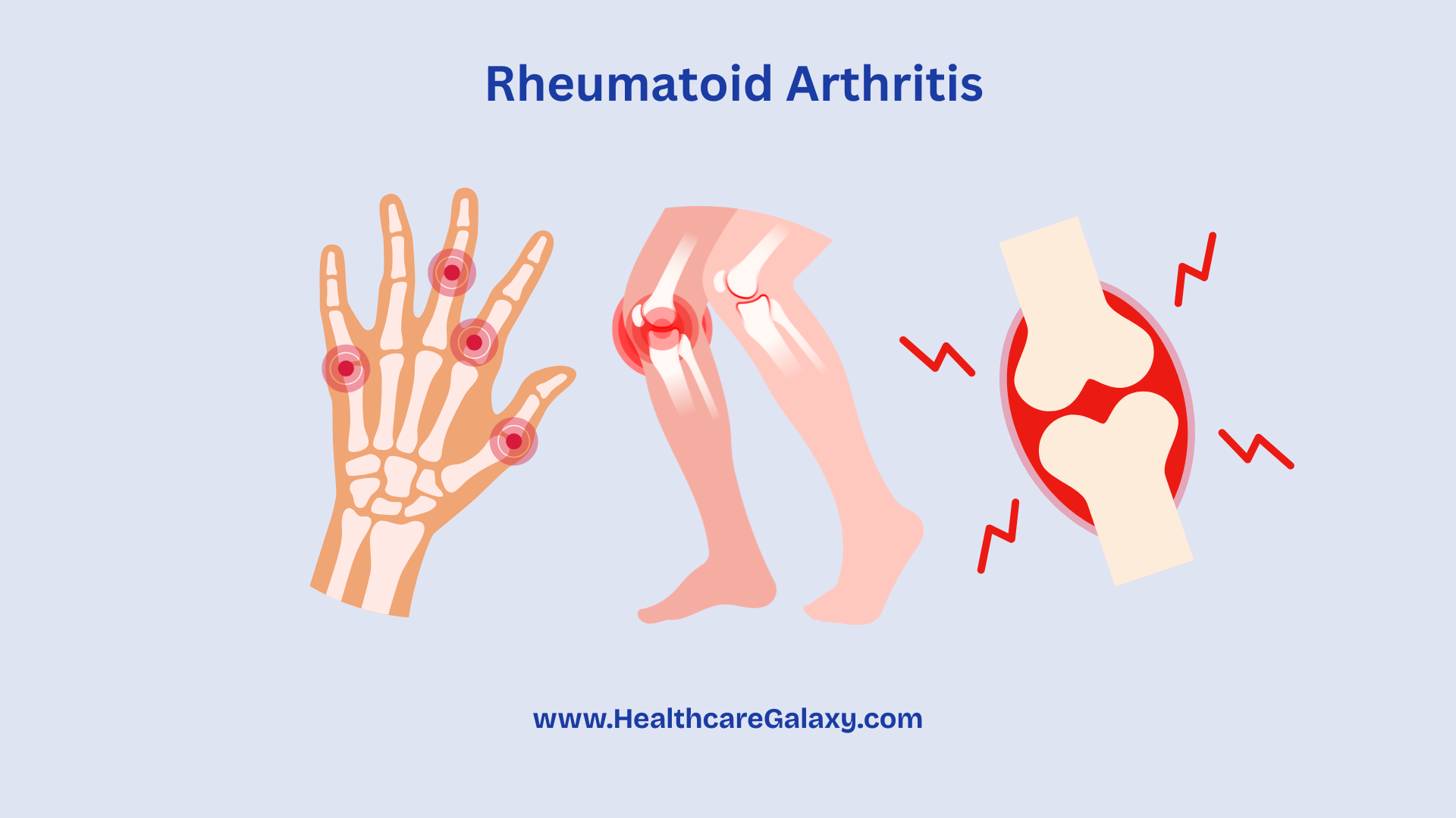 Rheumatoid Arthritis: Conquer Pain & Reclaim Your Life