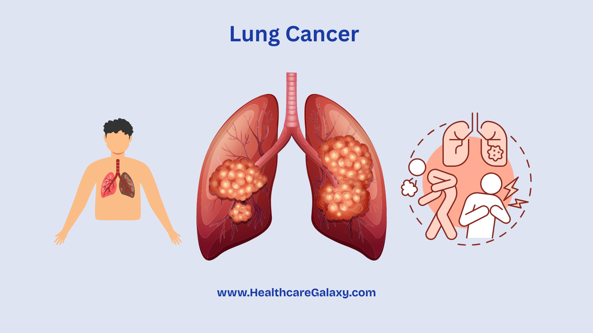 Lung Cancer: The Silent Killer You Can’t Ignore