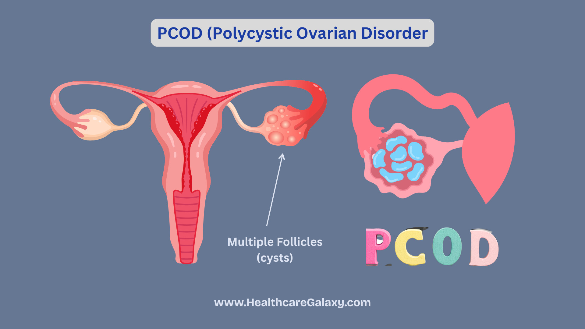 PCOD (Polycystic Ovarian Disorder)