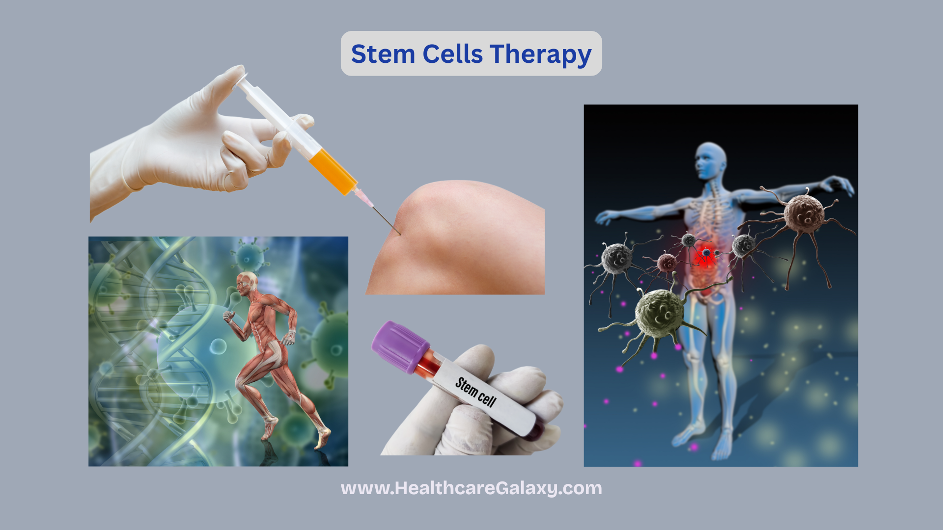 Stem Cell Therapy 